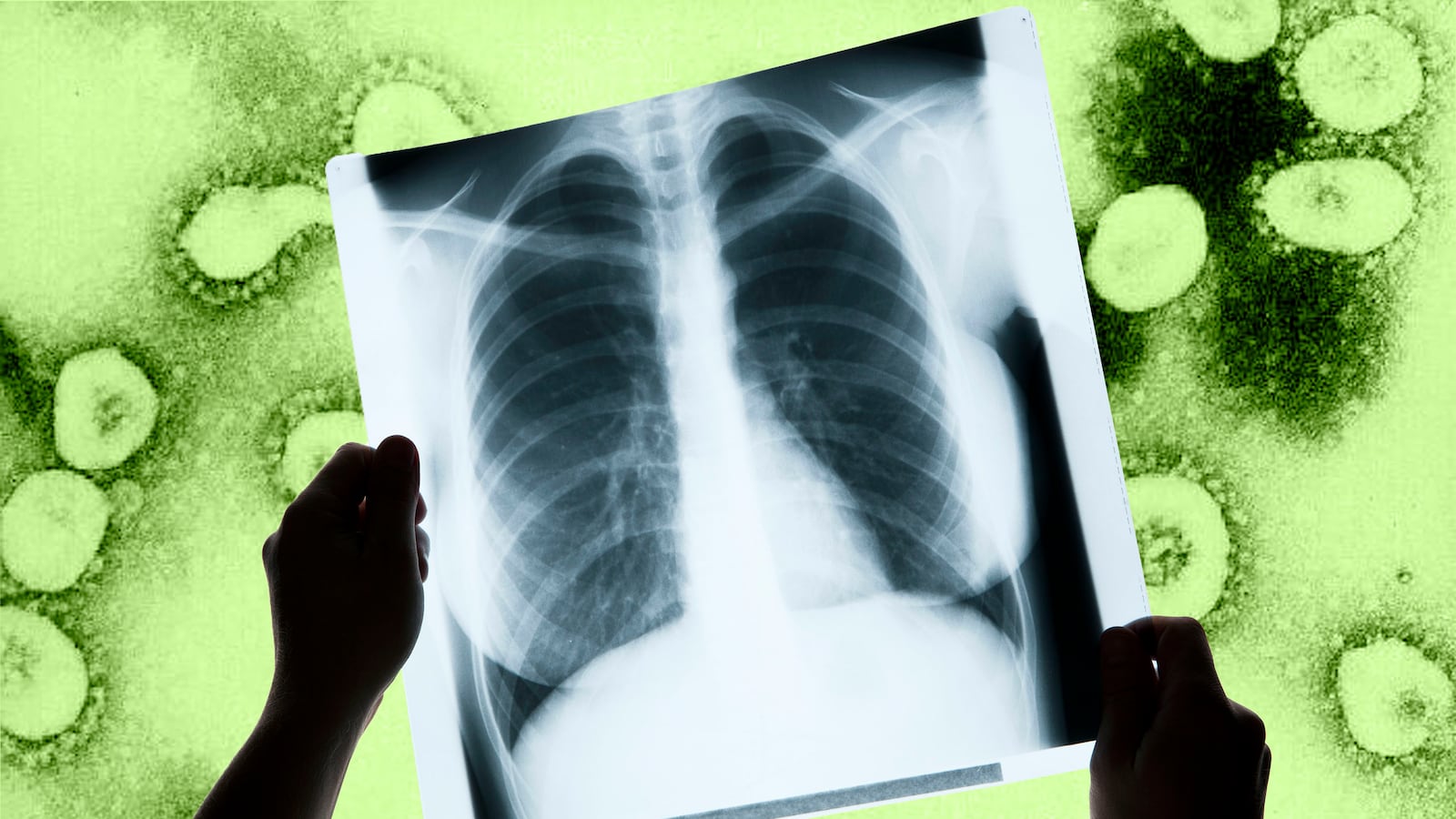 210114-shugerman-lung-transplants-tease_janysv