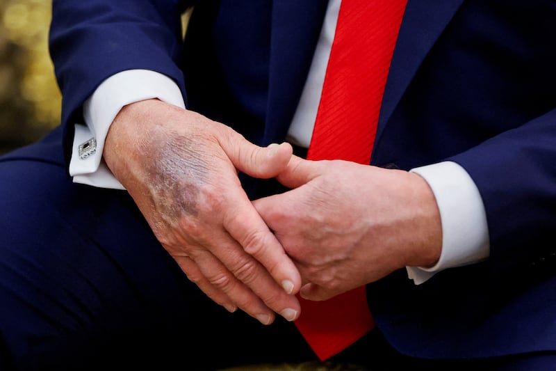 Trump's bruise was on display last August during a White House meeting with the president of South Korea.