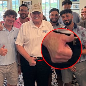 Trump hand shows discoloration in photos posted on X.