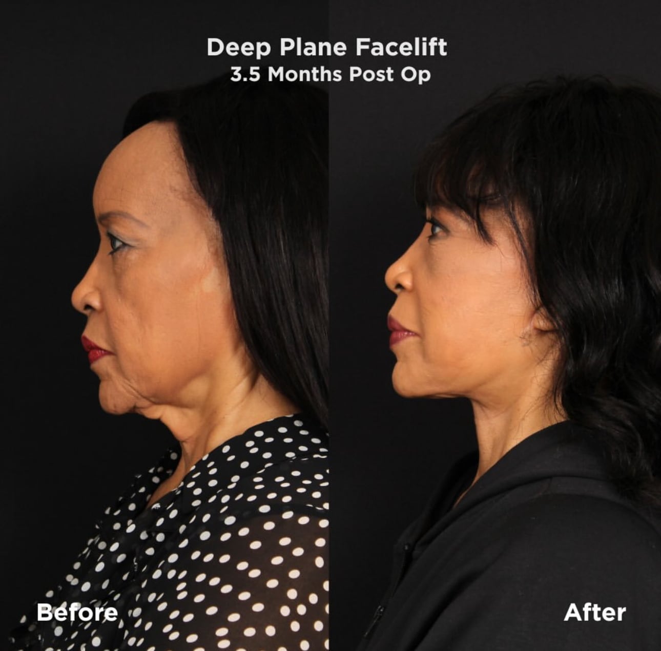 Jackée Harry's deep-plane facelift.
