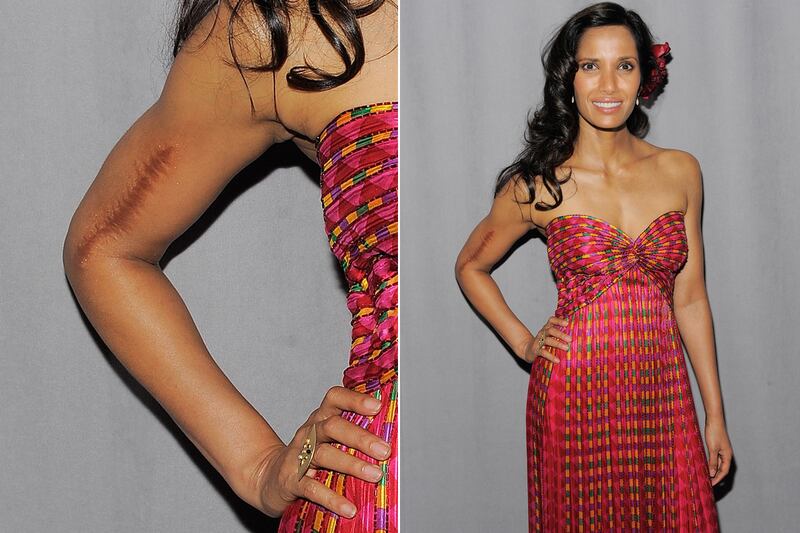 galleries/2011/12/01/kate-middleton-and-other-stars-with-scars-photos/stars-scars-lakshmi_vdfbgr