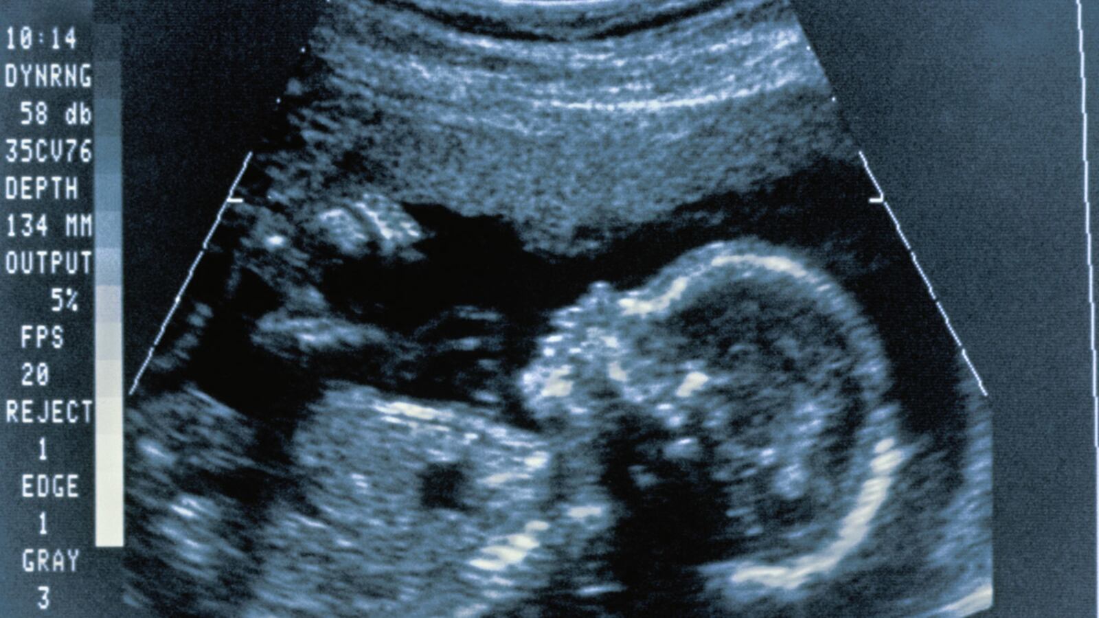 cheats/2011/08/30/texas-judge-strikes-down-law-that-mandated-women-have-sonogram-before-abortion/sonogram-cs_suiy2w