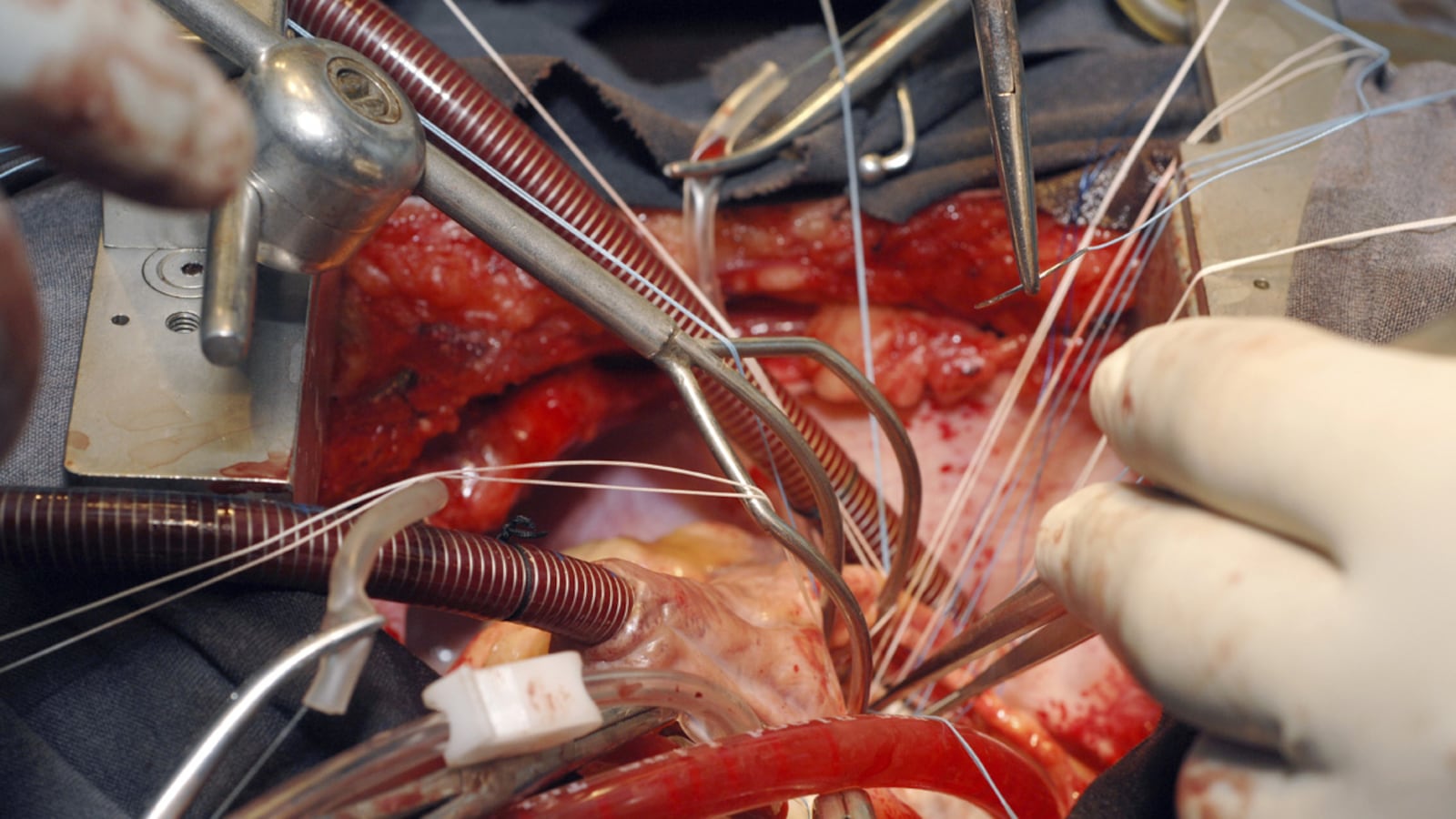 articles/2012/03/26/dick-cheney-surgery-7-essential-facts-about-heart-transplants/tbd-heart-transplants_ngpoh2