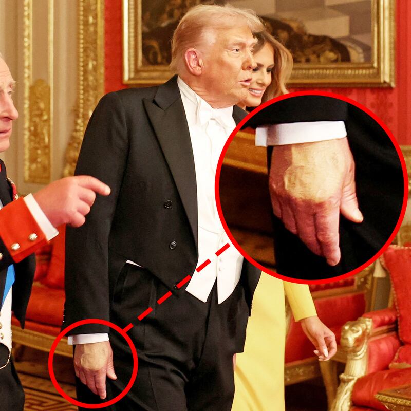 Red circle around Trump's hand makeup. Britain's King Charles, U.S. President Donald Trump and first lady Melania Trump walk to attend the State Banquet during U.S. President Donald Trump's state visit, at Windsor Castle, in Windsor, Britain, September 17, 2025.