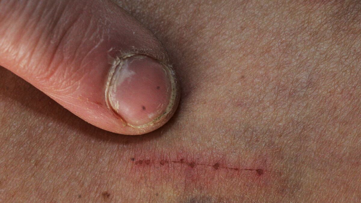 cheats/2012/01/26/new-study-ids-morgellons-disease/morgellons-disease-cs_siur7y