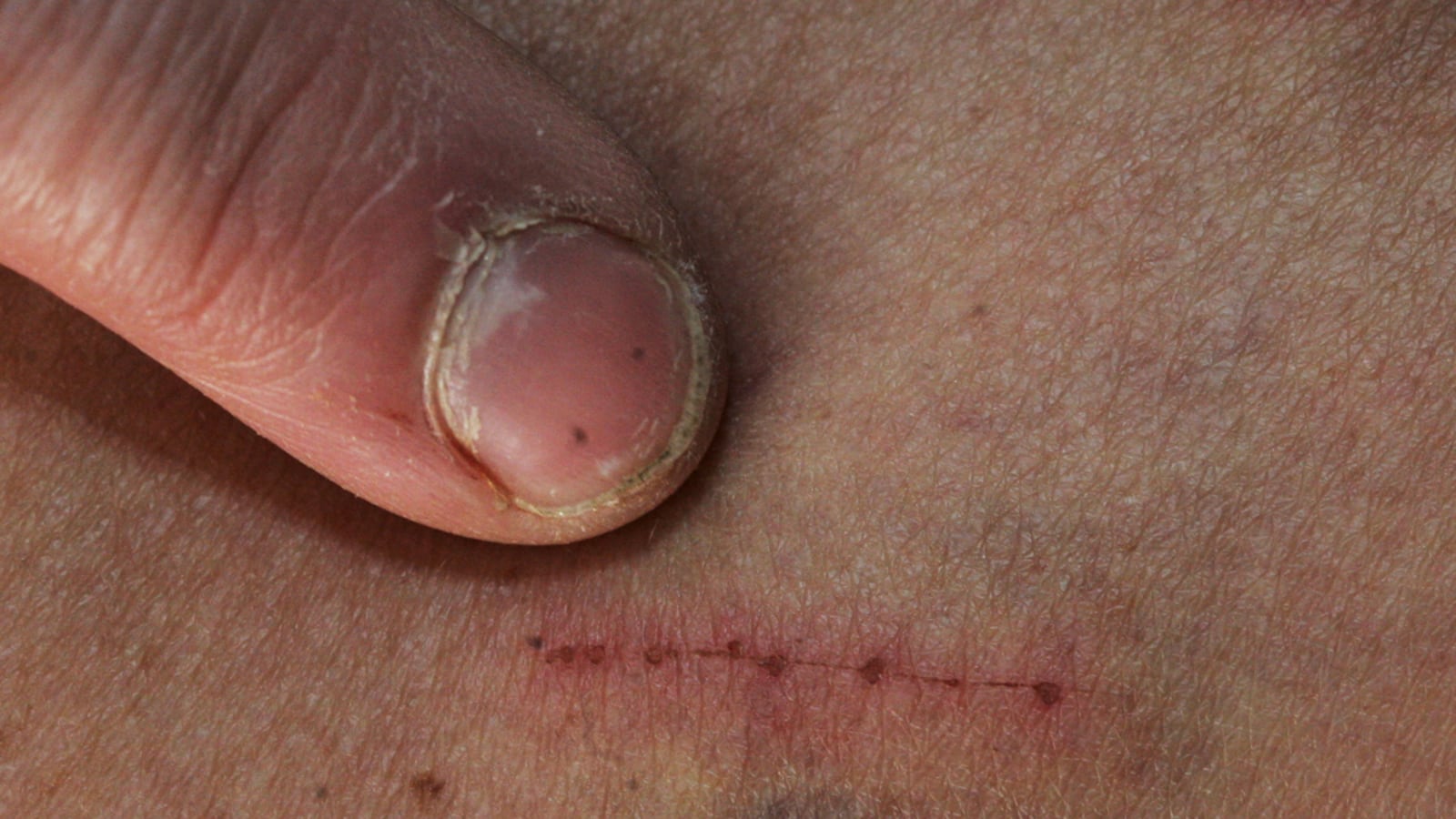 cheats/2012/01/26/new-study-ids-morgellons-disease/morgellons-disease-cs_siur7y