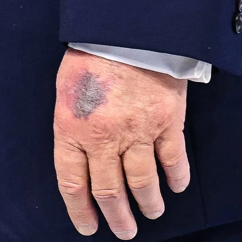 A bruise is visible on the back of US President Donald Trump's left hand as he walks at the "Board of Peace" meeting during the World Economic Forum (WEF) annual meeting in Davos on January 22, 2026.
