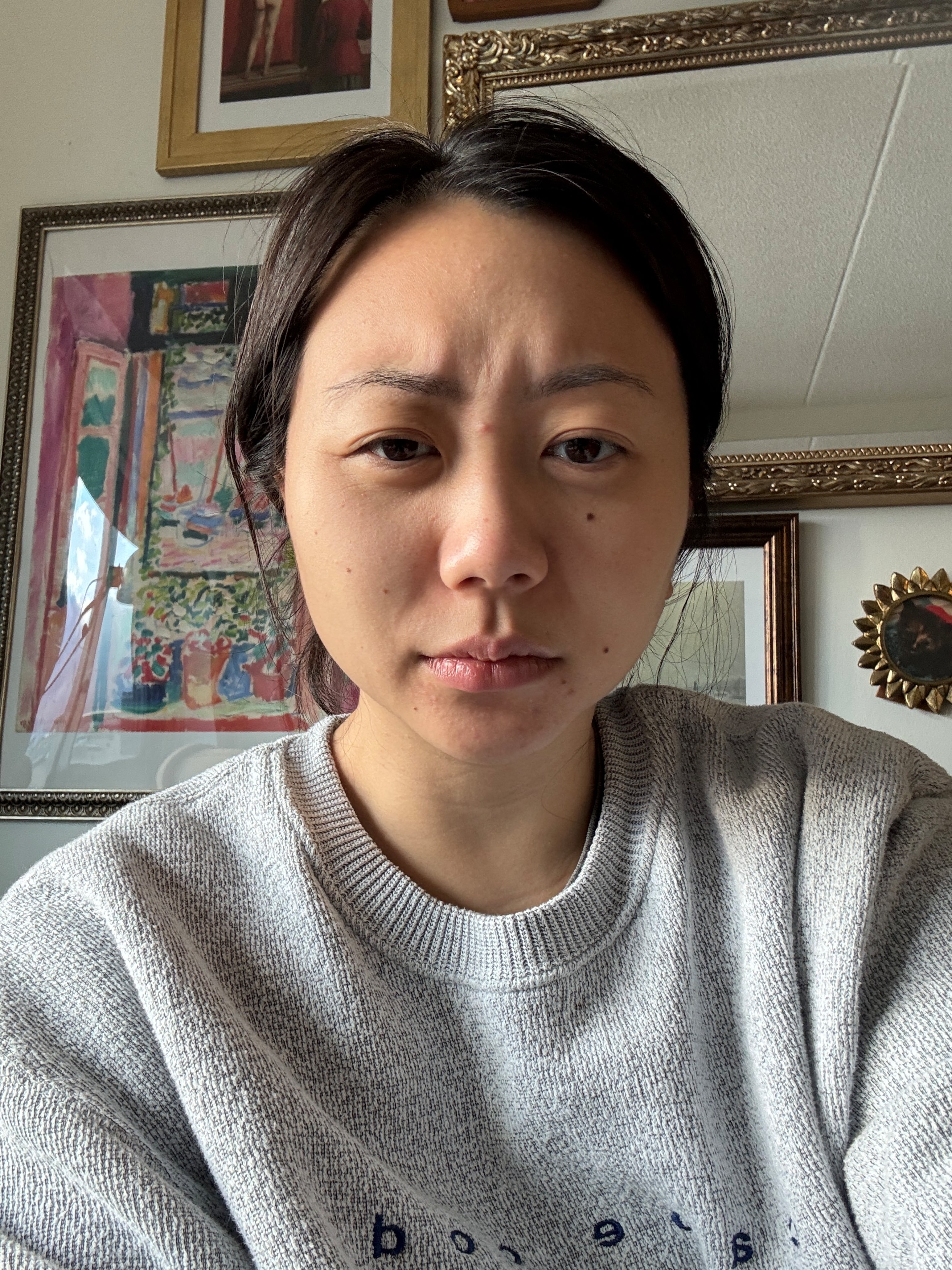 Frowning with baby botox.