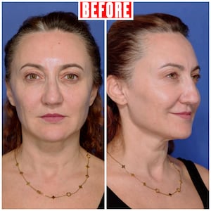 Looker - Her Upper Eyelid Surgery Took Just Two Hours But Took Years Off Her Face