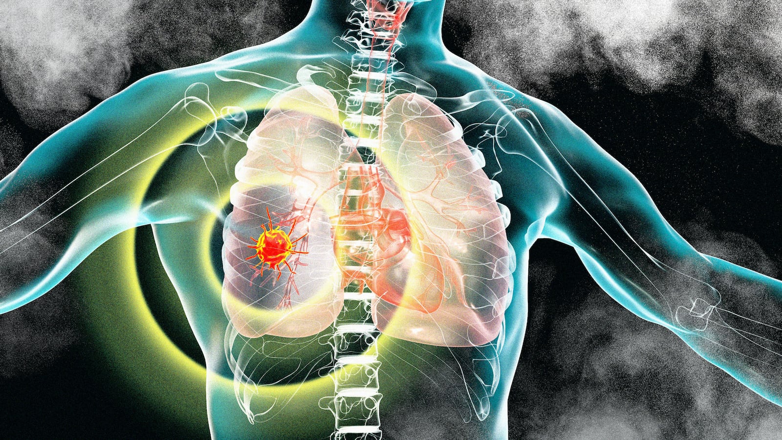 230405-Bender-lung-cancer-express-tease_hcg26d