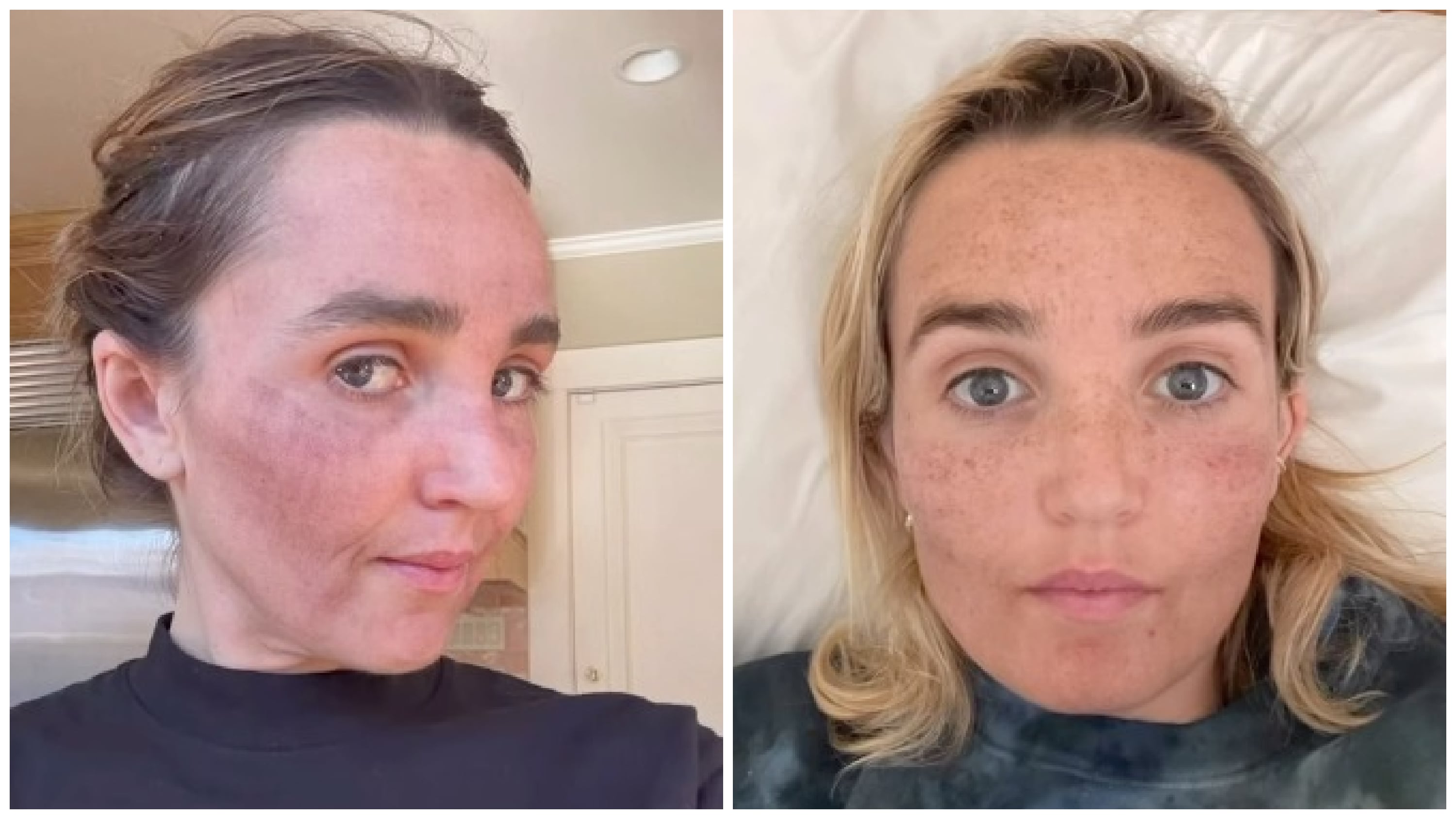 'Saturday Night Live' star Chloe Fineman posts photos from her 'Botched' album of her selfies after skincare treatments.