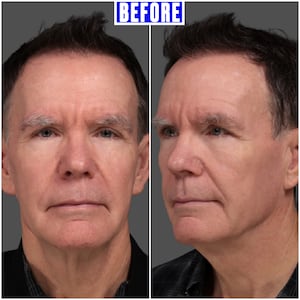 Before and After - The Looker - Man Undergoes Facelift After Noticing His Reflection Looked 'Angry'