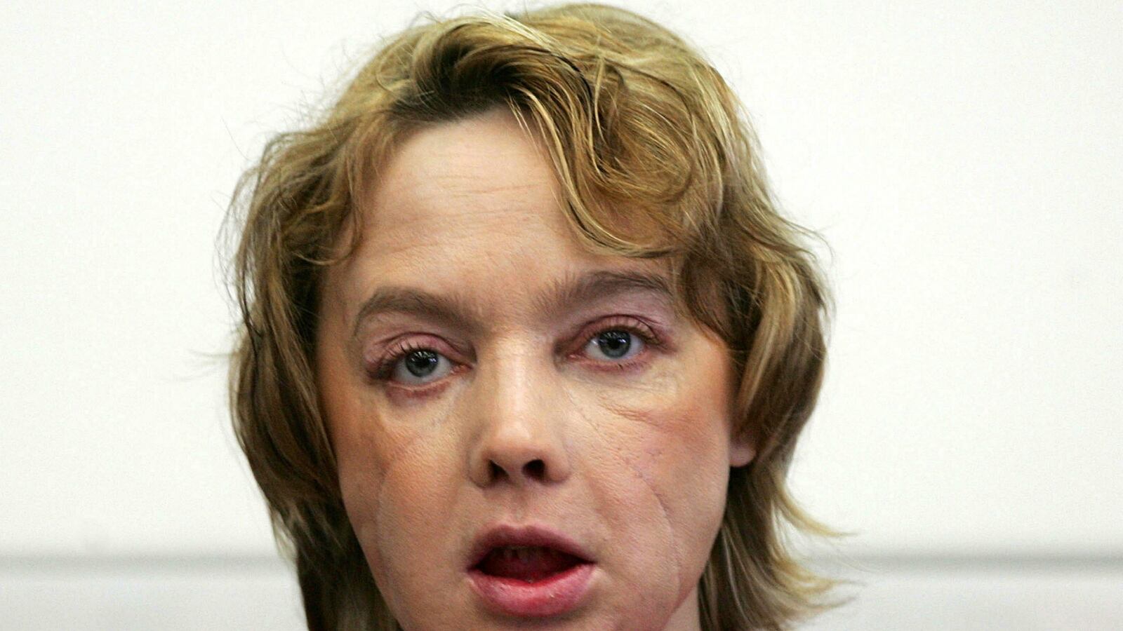 cheats/2016/09/06/first-face-transplant-recipient-dies/160906-face-transplant-death-cheat_nzsjo8