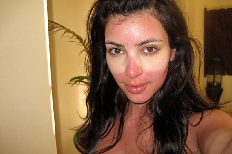 galleries/2011/07/04/celebrity-sunburns-kim-kardashian-simon-cowell-and-more/kardashain-worst-celebrity-sunburns_qze66u