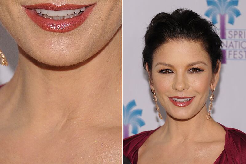 galleries/2011/12/01/kate-middleton-and-other-stars-with-scars-photos/stars-scars-zeta-jone_xtitou